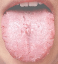 schimmelinfectie mond natuurlijk behandelen
