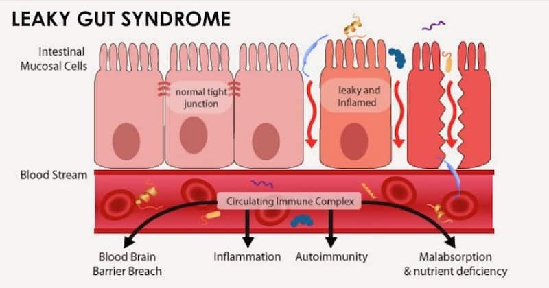 leaky gut symptoms